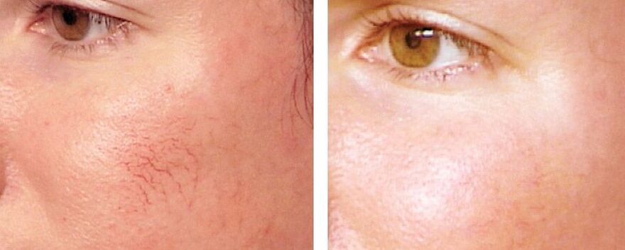 Removal of rosacea