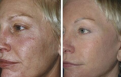 fractional laser rejuvenation before and after pictures
