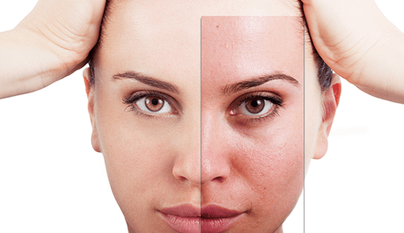 fractional rejuvenation removes the most important aesthetic defects of the face