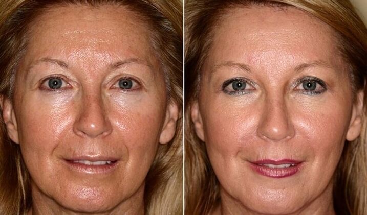 before and after skin rejuvenation of the face at home
