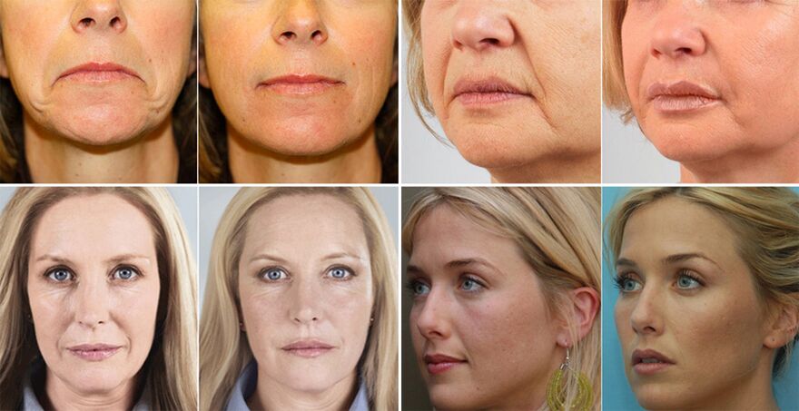 pictures of women before and after skin rejuvenation on the face