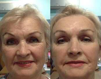 experience using Goji Cream anti-wrinkle cream - personal image before and after